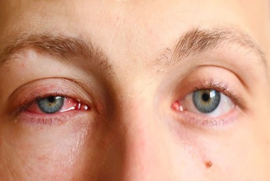Bệnh đau mắt đỏ và cách phòng tránh